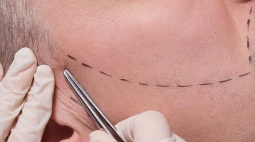 Implant barbe : tout savoir sur la greffe de barbe.