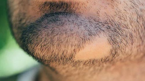 Pelade de barbe : Causes et traitements.