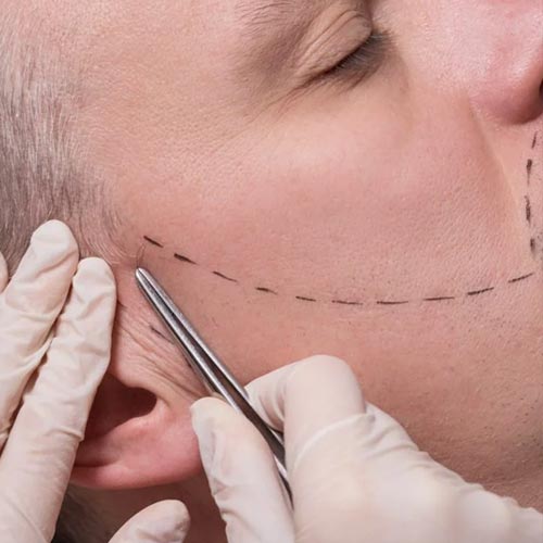 Implant barbe : tout savoir sur la greffe de barbe.