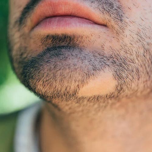Pelade de barbe : Causes et traitements.